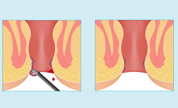 Laser Haemorrhoidectomy or Piles