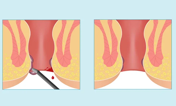 Laser Haemorrhoidectomy or Piles