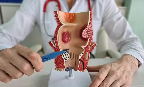 Laser Fissure Surgery