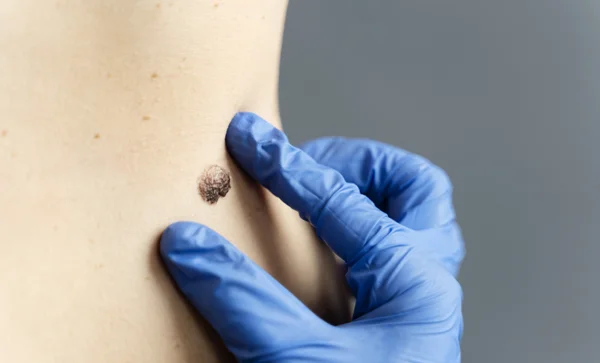 Laser Surgery