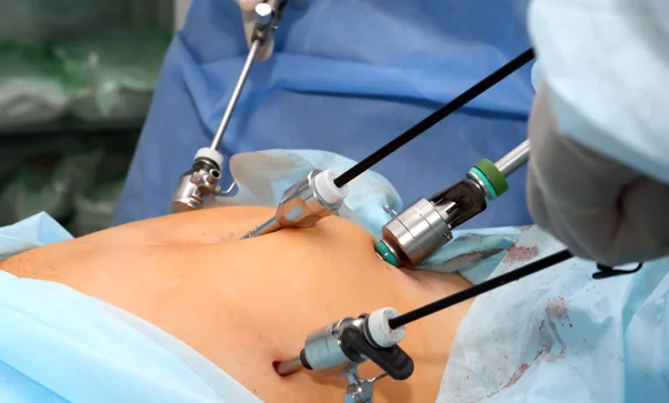 Laparoscopic and Robotic Colo Rectal Surgery