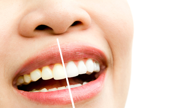 Teeth Whitening