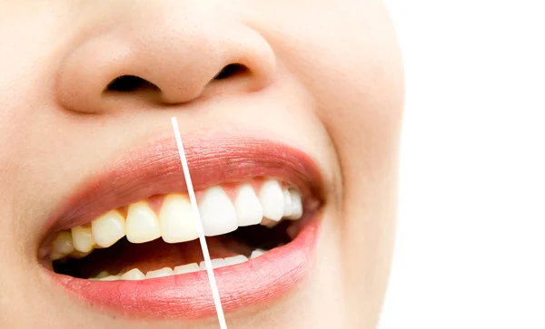 Teeth Whitening