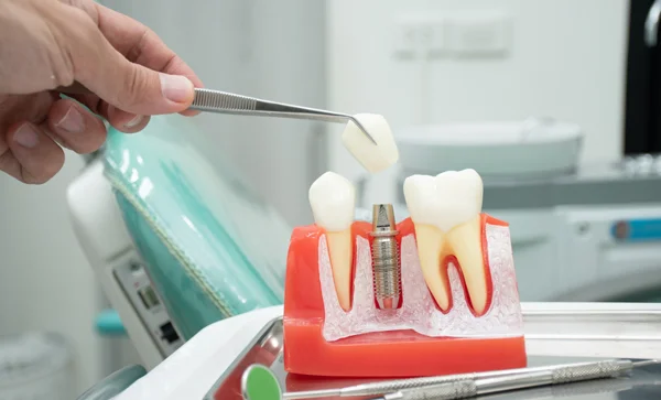 Implant Restoration