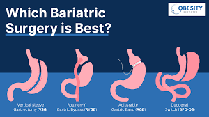 When Is Weight Loss Surgery the Right Decision?